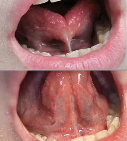 Frenectomy at Alameda Pediatric Dentistry