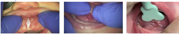 Frenectomy at Alameda Pediatric Dentistry
