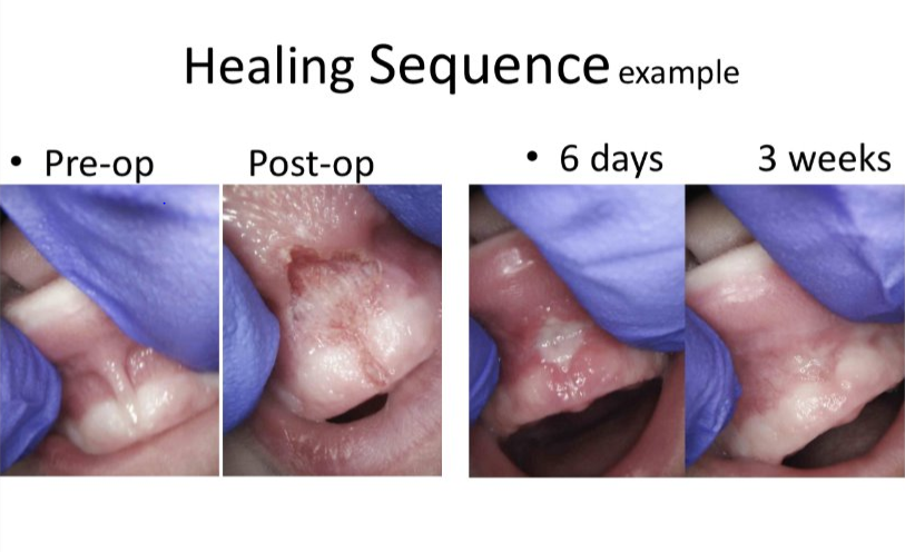 Frenectomy at Alameda Pediatric Dentistry