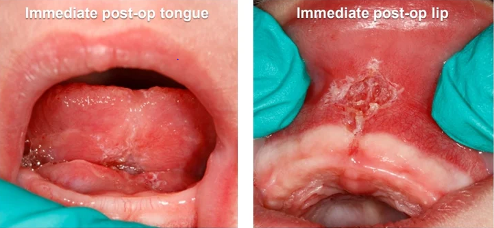 Frenectomy at Alameda Pediatric Dentistry