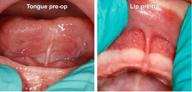 Frenectomy at Alameda Pediatric Dentistry
